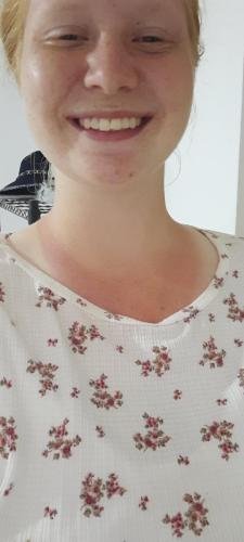 A slefie of Alyssa with a bad neck sunburn