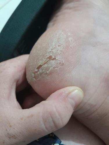 Alyssa's rough looking heel