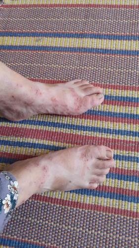 Alyssa's nasty looking feet with all their sores and wounds